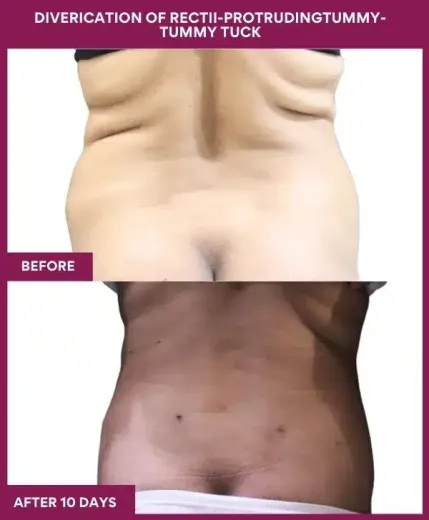12 DIVERICATION OF RECTII-PROTRUDINGTUMMY- TUMMY TUCK (6)_7_