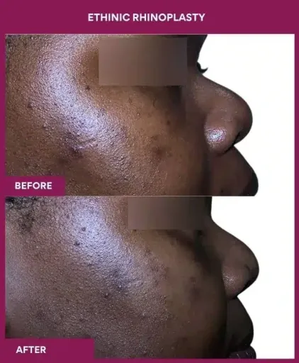 12 ETHINIC RHINOPLASTY in Mumbai, India