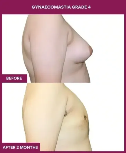 12- GYNAECOMASTIA GRADE 4_