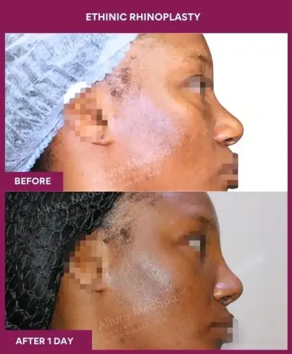 13 ETHINIC RHINOPLASTY in Mumbai, India