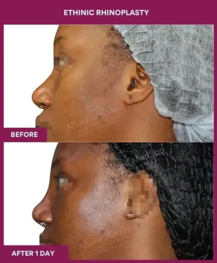 13 ETHINIC RHINOPLASTY in Mumbai, India