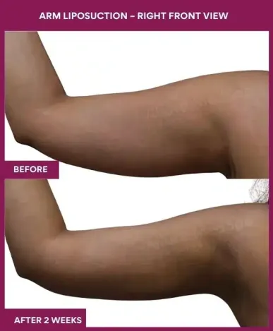 15 Arm Liposuction – Right Front View