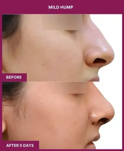 15 MILD HUMP in Mumbai, India