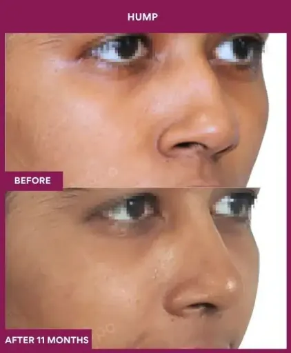 16 hump Nose in Mumbai, India