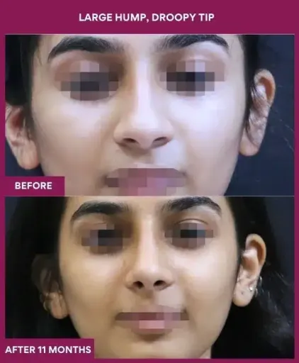 17 large Hump, droopy tip in Mumbai, India