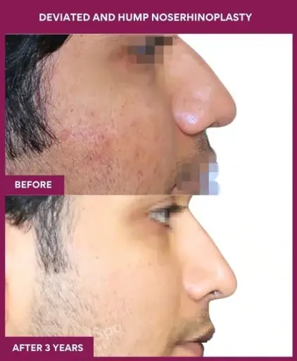 18 DEVIATED AND HUMP NOSERHINOPLASTY in Mumbai, India