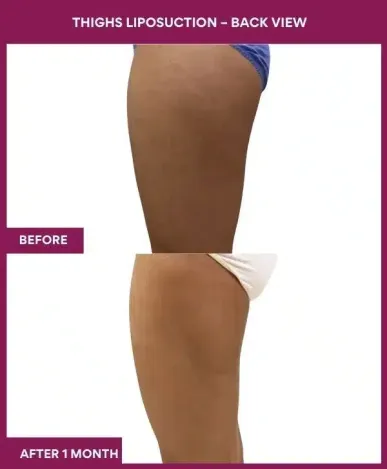 18 Thighs Liposuction – Back View--