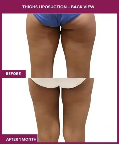 18 Thighs Liposuction – Back View