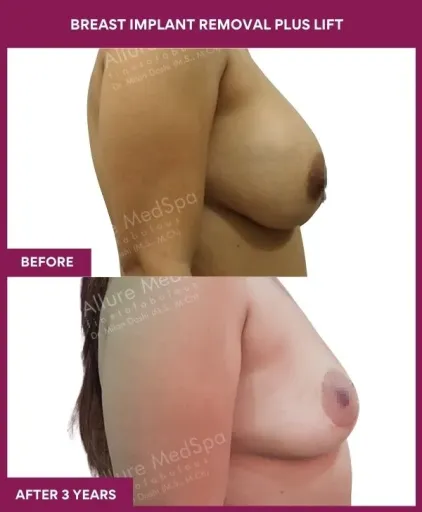 2 Breast Implant Removal Plus Lift (3)_4_