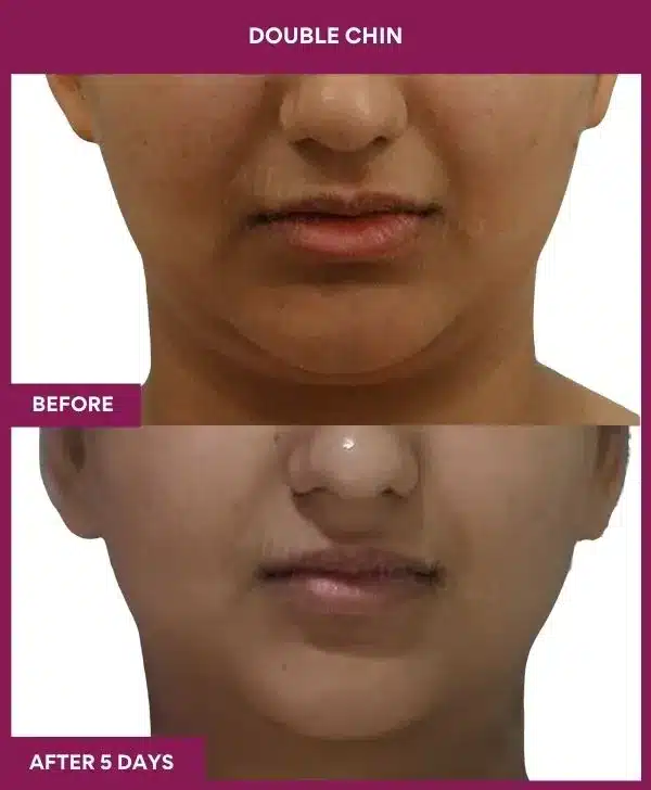 2 Double Chin (3)_52