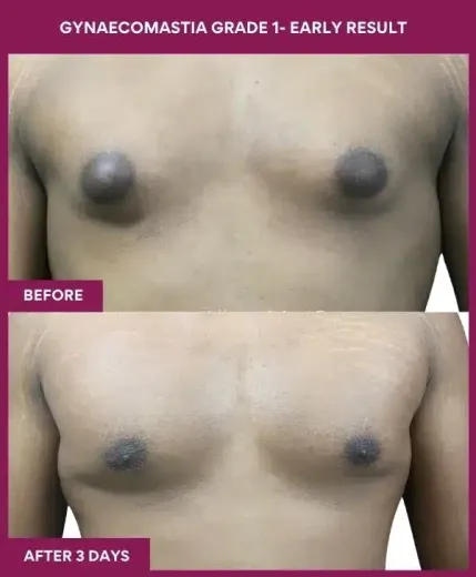 2- GYNAECOMASTIA GRADE 1- EARLY RESULT_6