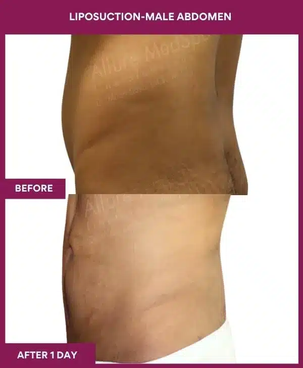 2 LIPOSUCTION-MALE ABDOMEN_6_ (3)