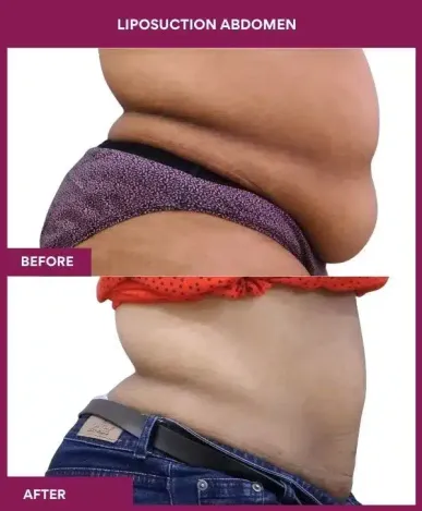 2- liposuction abdomen-