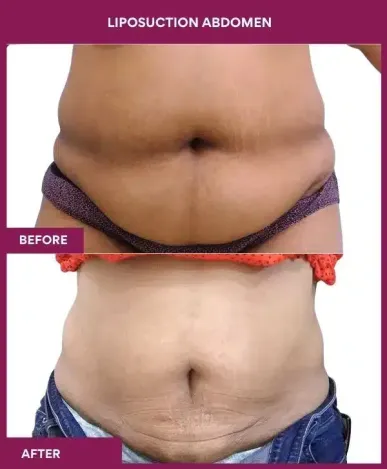 2- liposuction abdomen