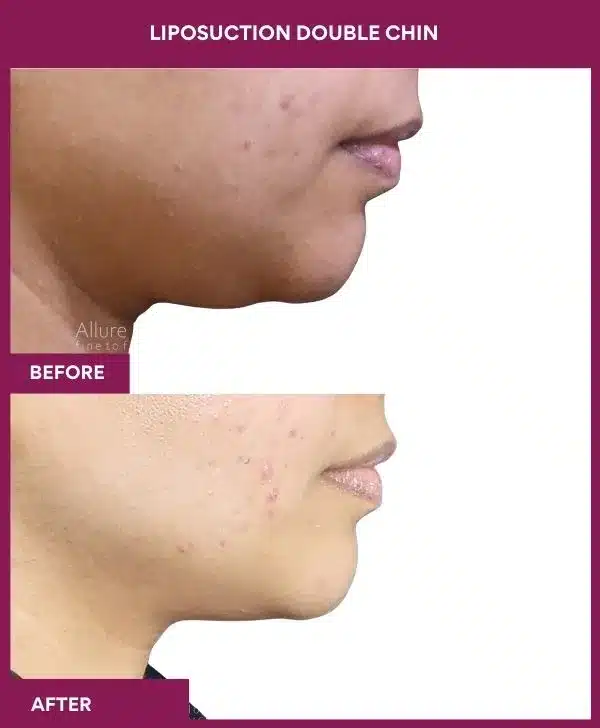 23 LIPOSUCTION DOUBLE CHIN