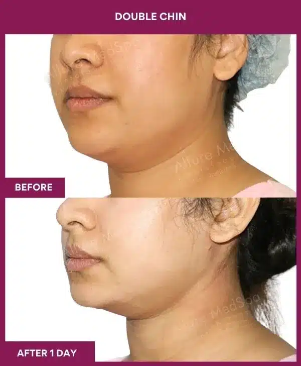 3 Double Chin (3)_54