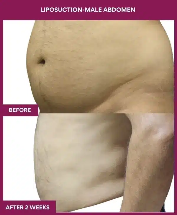 3 LIPOSUCTION-MALE ABDOMEN (3)_8_