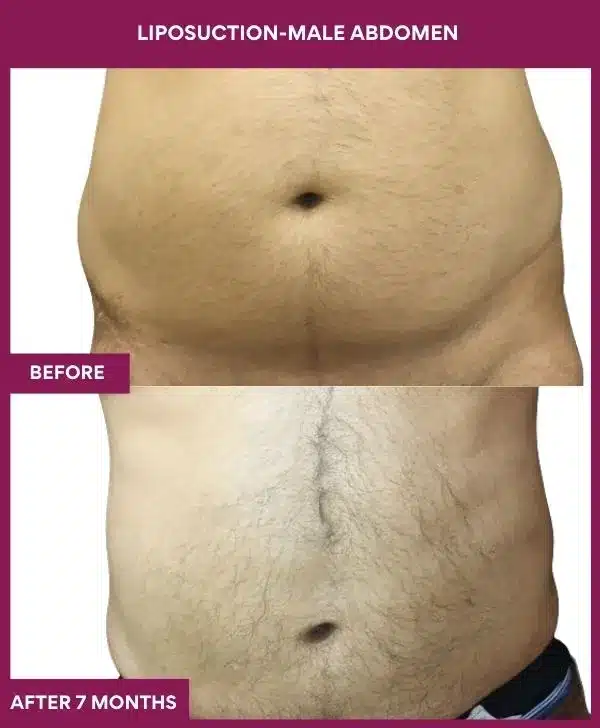 3 LIPOSUCTION-MALE ABDOMEN (4)_8_