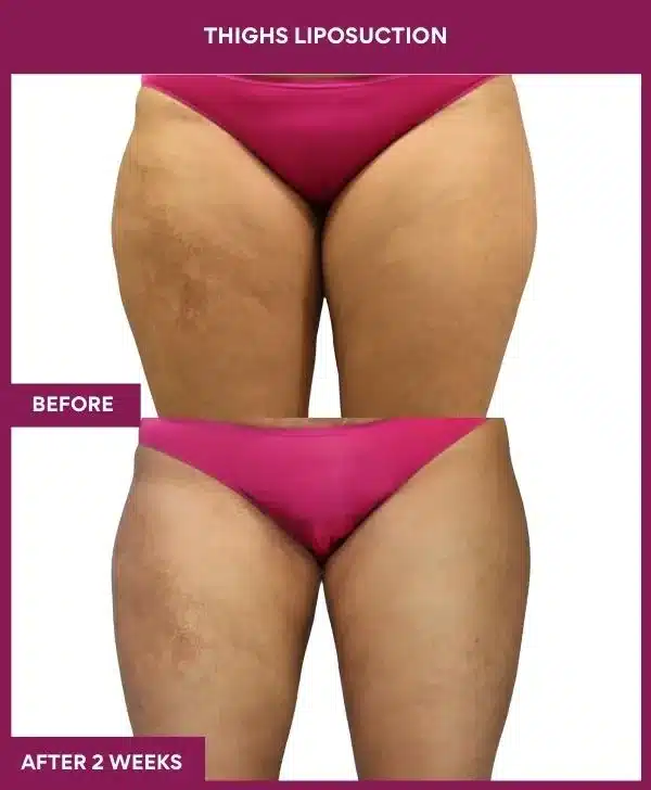 3 Thighs Liposuction (4)_77