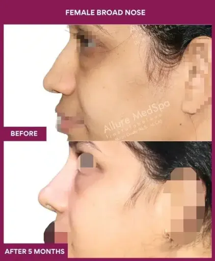 3 female BROAD NOSE in Mumbai, India