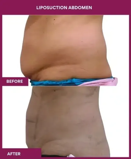 3- liposuction abdomen--