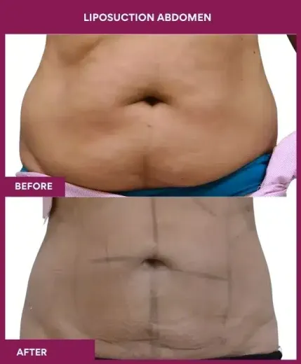 3- liposuction abdomen