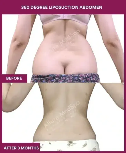4- 360 DEGREE LIPOSUCTION ABDOMEN--