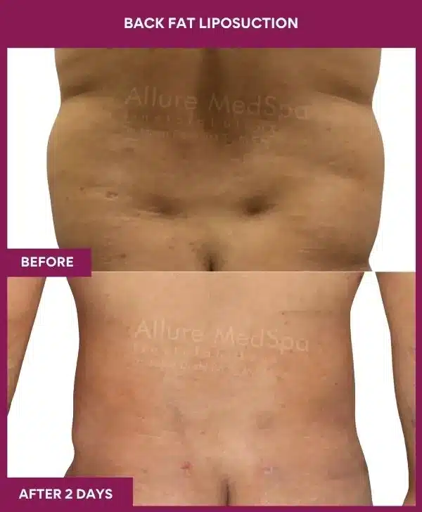 4 Back Fat Liposuction_38