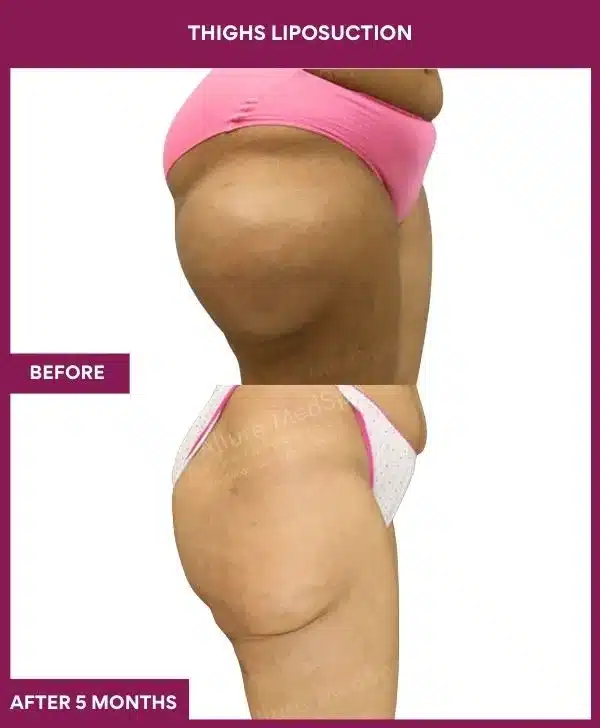 4 Thighs Liposuction_83 (2)