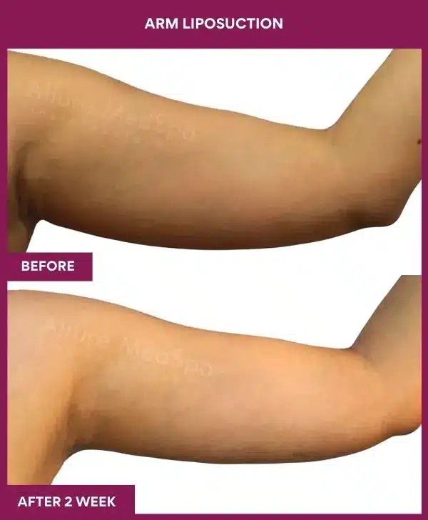 5 Arm Liposuction_34 (1)