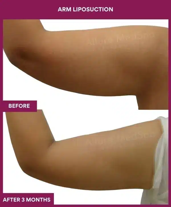 5 Arm Liposuction_34 (2)