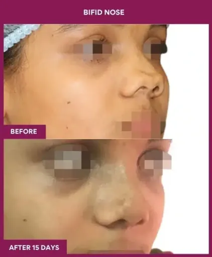 5 BIFID NOSE surgery in Mumbai, India