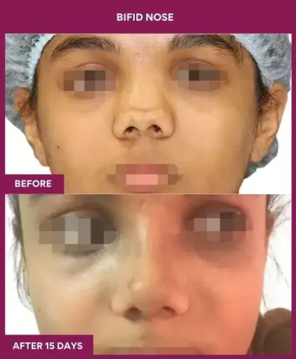 5 BIFID NOSE surgery in Mumbai, India
