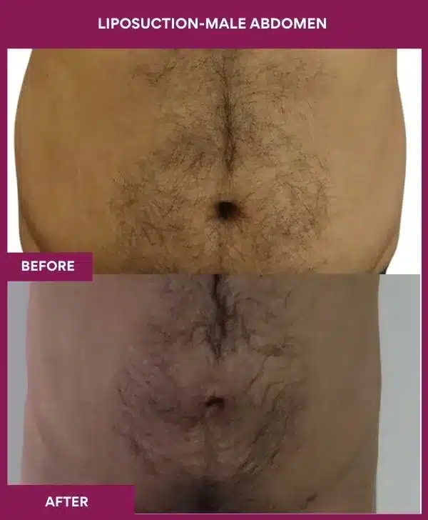 5 LIPOSUCTION-MALE ABDOMEN_12_