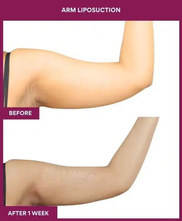6 Arm Liposuction (4)_24_