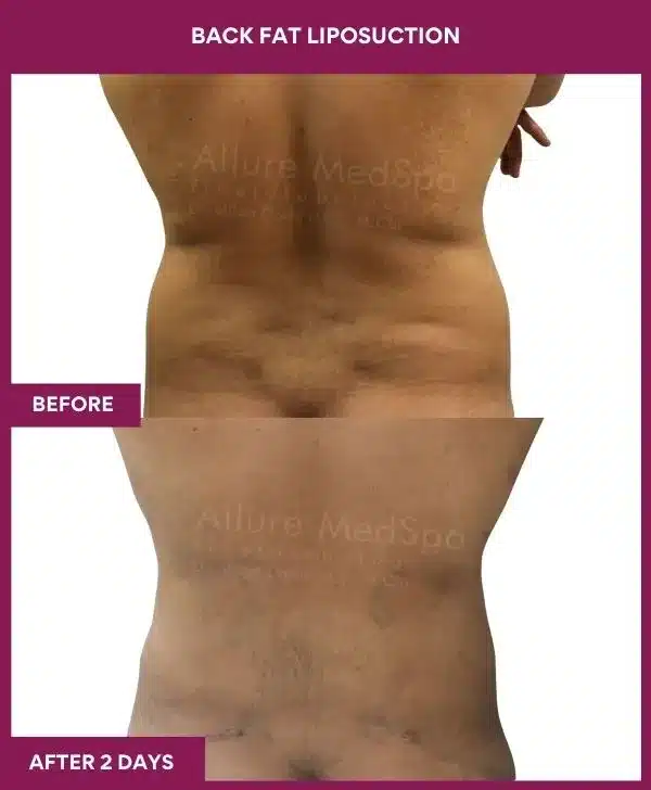 6 Back Fat Liposuction_40