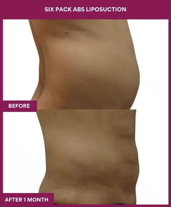6 Six Pack Abs Liposuction_71 (2)