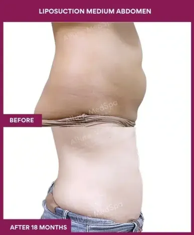 6- liposuction medium abdomen-