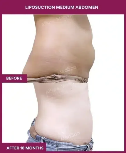 6- liposuction medium abdomen-
