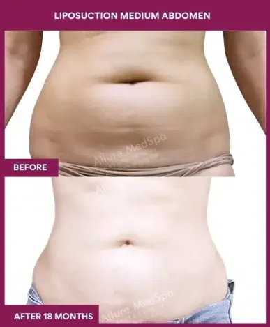 6- liposuction medium abdomen