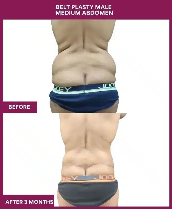 7 BELT PLASTY MALE MEDIUM ABDOMEN (6)_11