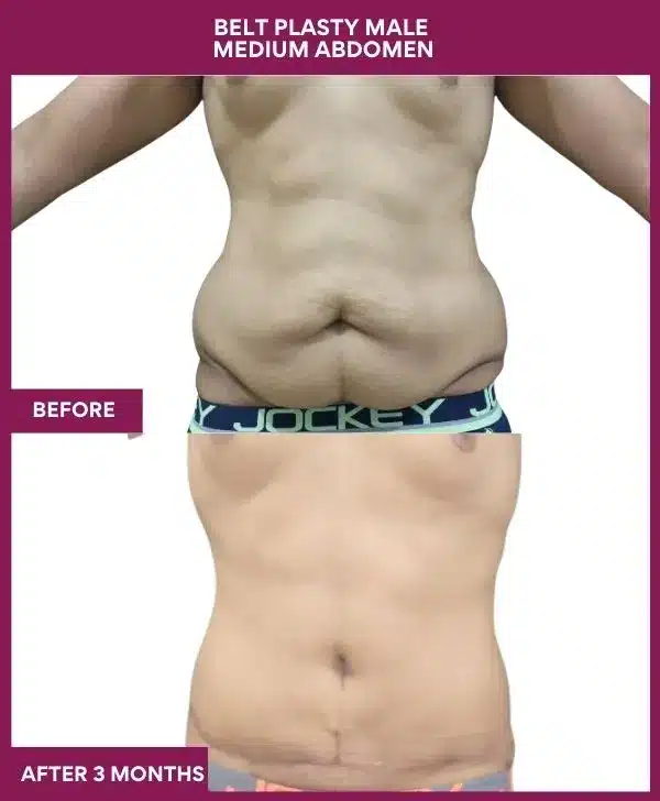 7 BELT PLASTY MALE MEDIUM ABDOMEN (7)_11