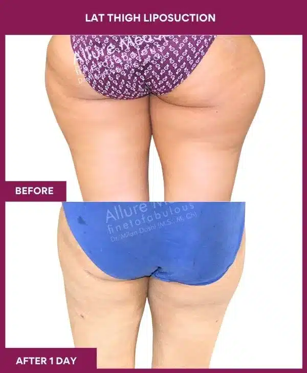 7 LAT THIGH LIPOSUCTION-- (1)
