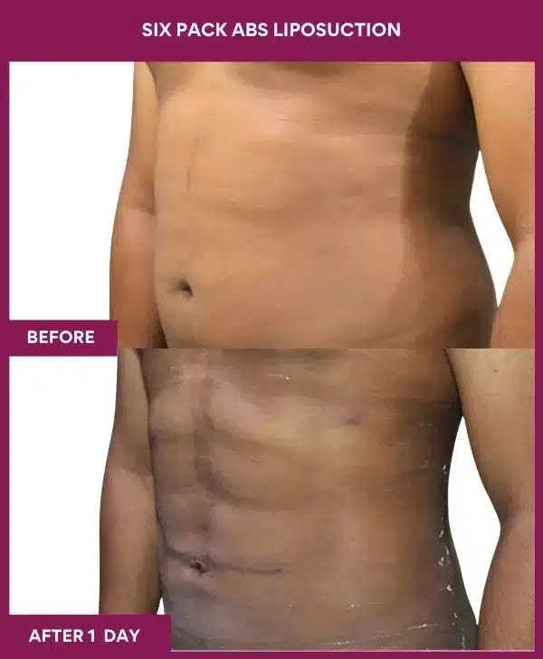 7 Six Pack Abs Liposuction (6)_67