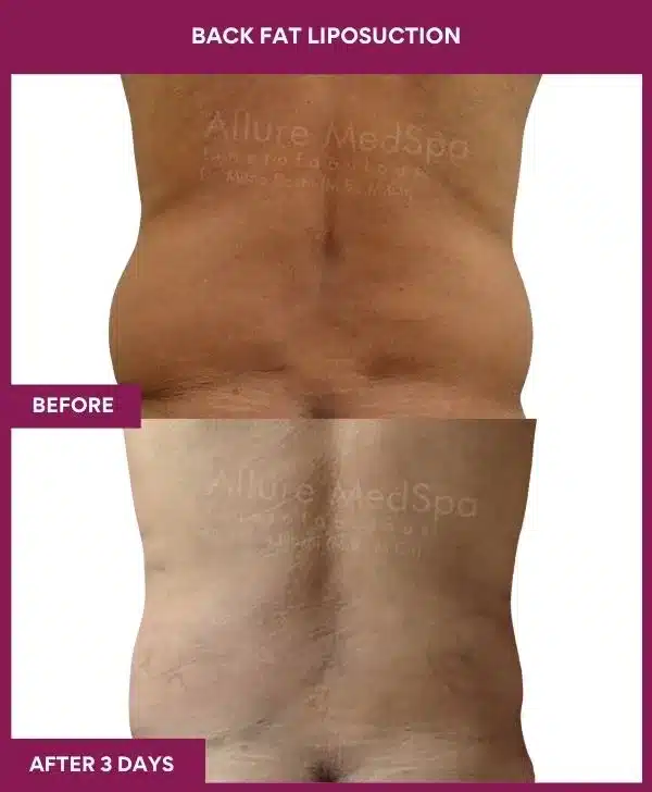 8 Back Fat Liposuction_41