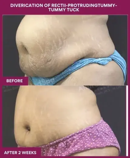 8 DIVERICATION OF RECTII-PROTRUDINGTUMMY- TUMMY TUCK_6_ (3)