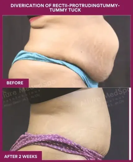 8 DIVERICATION OF RECTII-PROTRUDINGTUMMY- TUMMY TUCK_6_ (4)