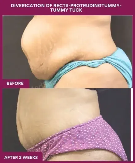 8 DIVERICATION OF RECTII-PROTRUDINGTUMMY- TUMMY TUCK_6_ (5)