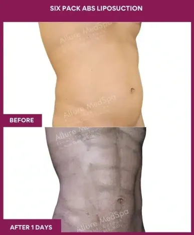 8- Six Pack Abs Liposuction--