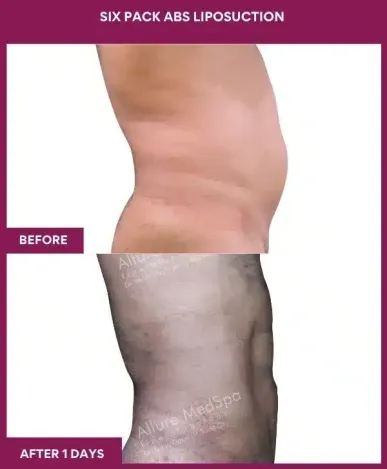 8- Six Pack Abs Liposuction-